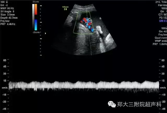 胎儿宫内缺氧超声表现