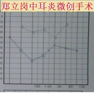 郑立岗中耳乳突炎微创手术第654江苏南通崇川