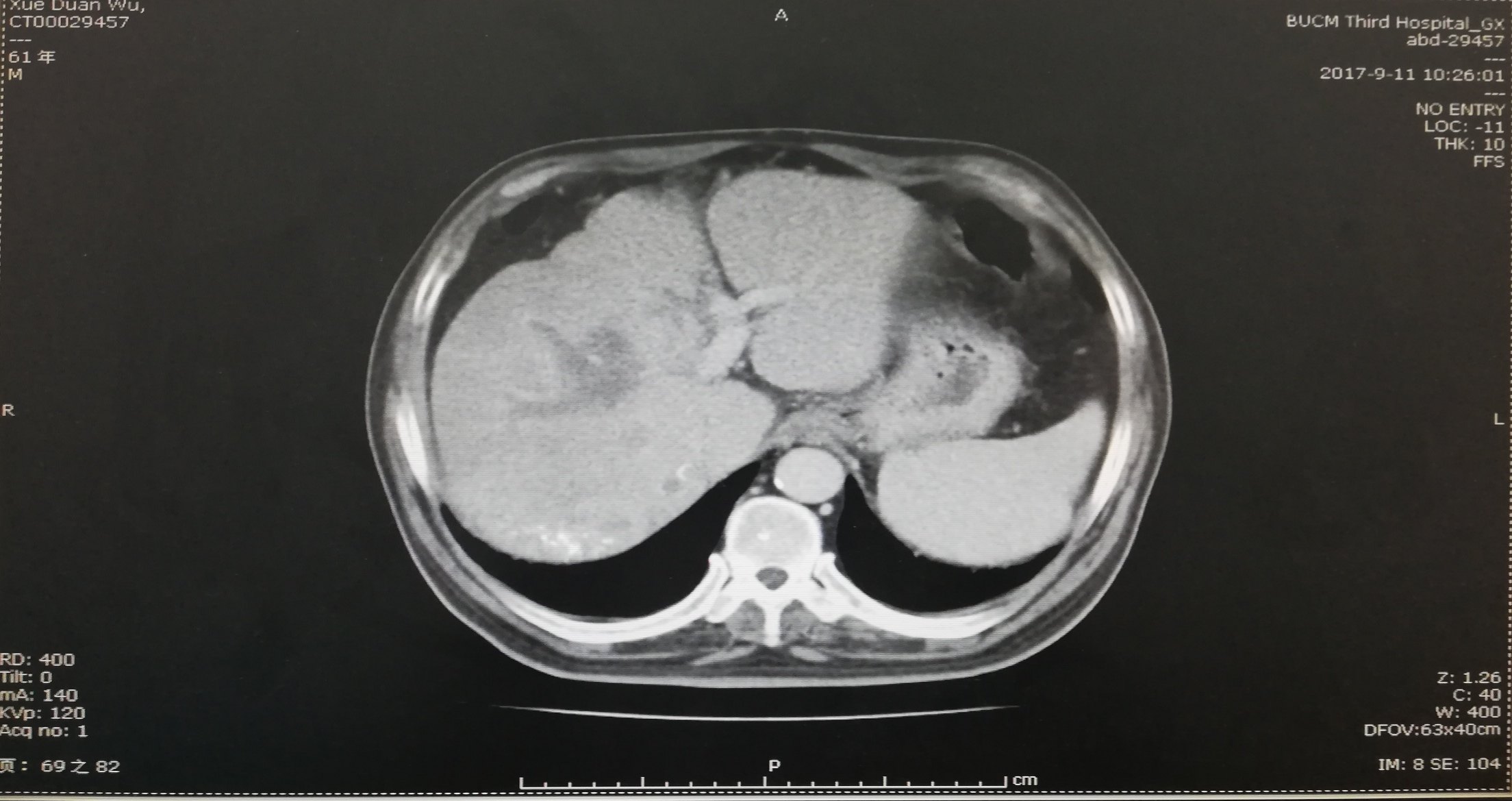 9.11腹部增强ct:肝右叶弥漫性肝癌