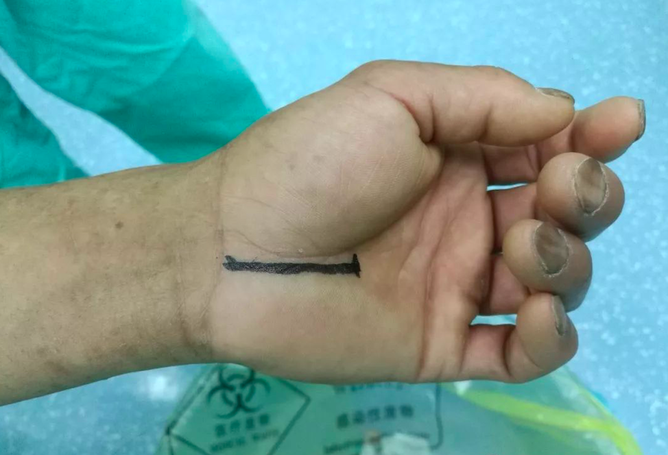 神经卡压综合症手术治疗之腕管综合症