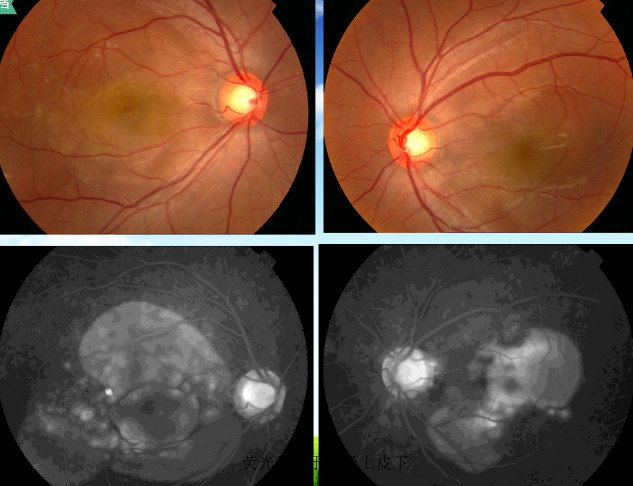 眼底荧光血管造影详细介绍