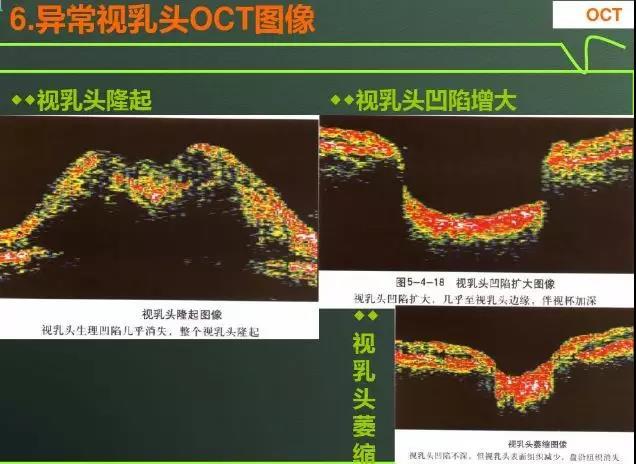 清晰的显示眼后段主要是黄斑和视乳头的形态特征,视网膜的层间结构