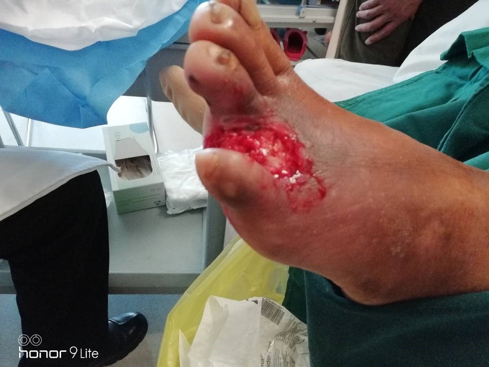 病人疼痛缓解,术后的患肢经皮氧分压为54mmhg,接着清创把坏疽的足趾