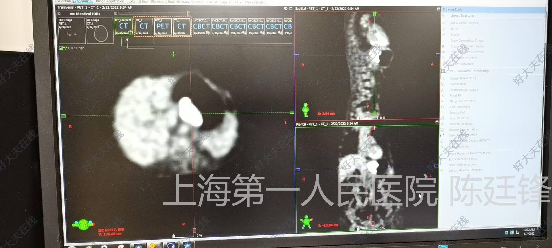 pet/ct示:贲门癌伴淋巴结转移可能,患者年龄大,拒绝手术.