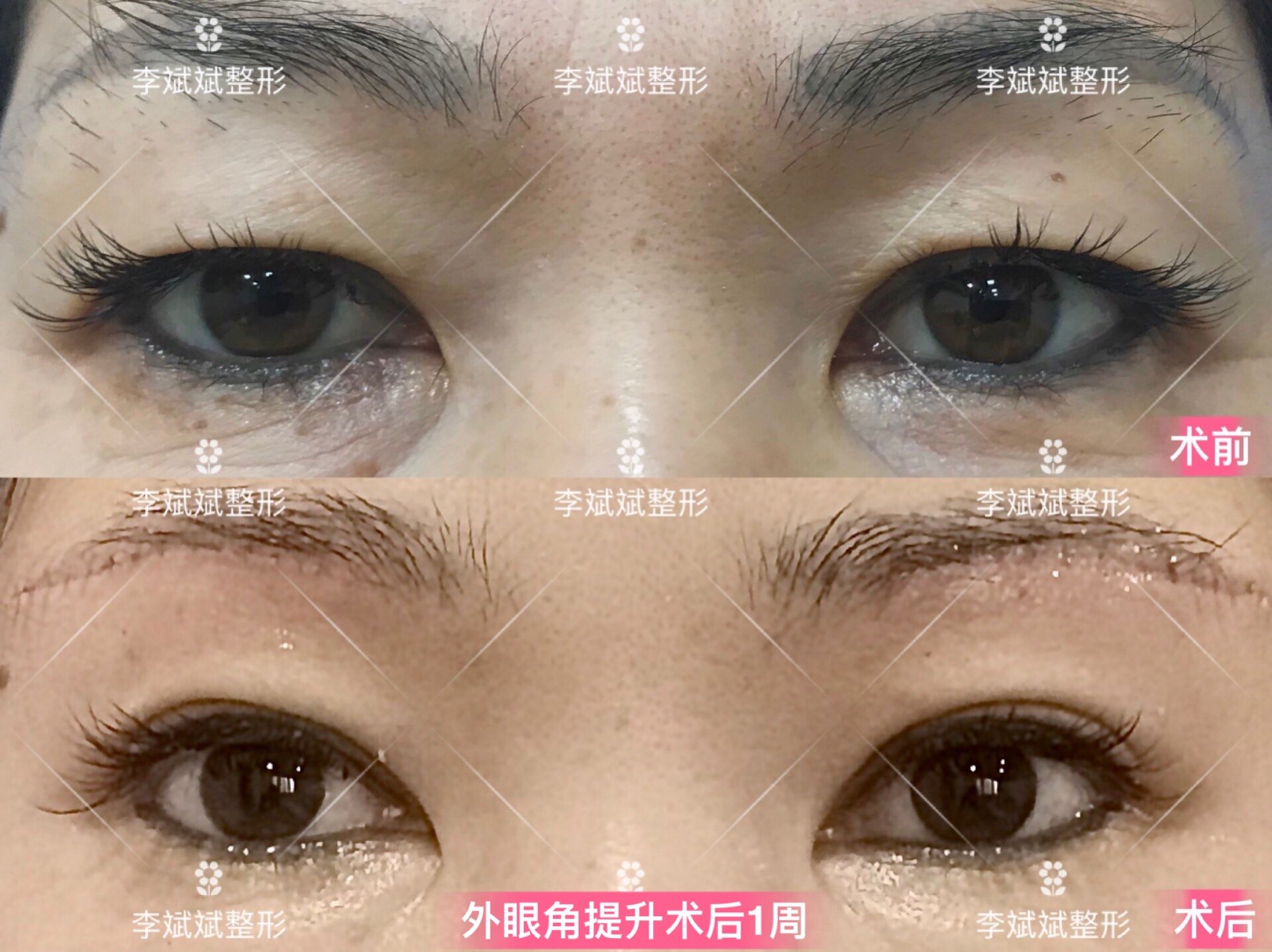 外眼角提升外眼角提升案例合集