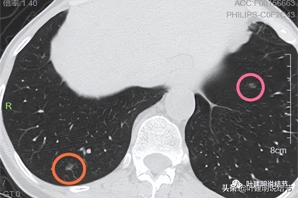 恼人的肺多发结节两肺多达36枚结节如何是好