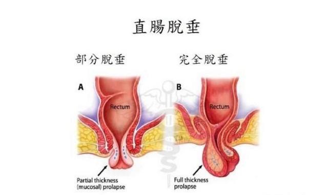 小朋友直肠脱垂嵌顿