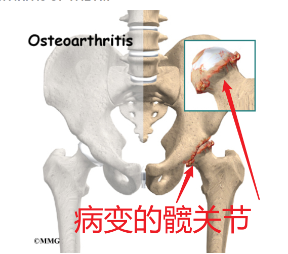 人工髋关节置换术问答--北京大学深圳医院骨关节科马泽涛大夫