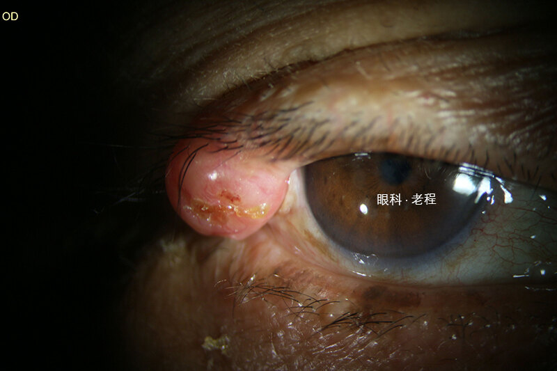 睑板腺囊肿,表现为眼睑的淡红色肉芽肿性结节眼睑皮脂腺癌,表现为局限