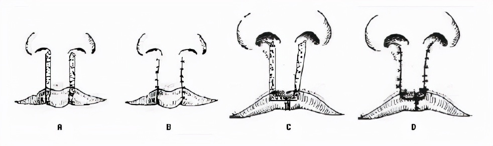 科普双侧唇裂二期修复手术的切口是怎样设计的