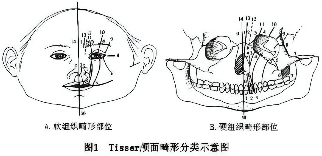 先天性面裂鼻畸形的诊断与治疗_鼻部整形 好大夫在线