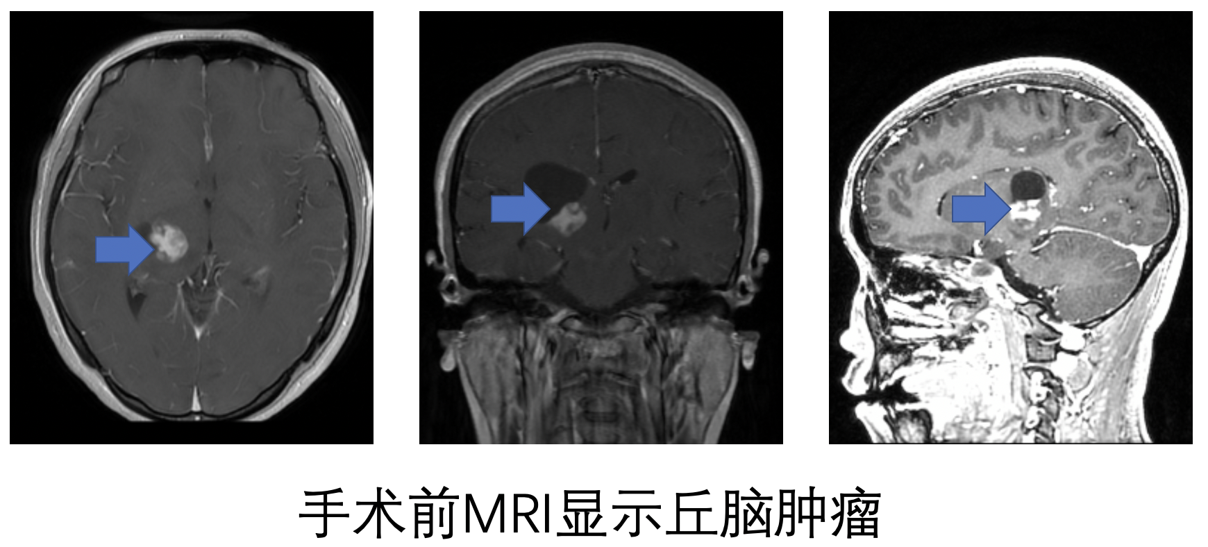 丘脑胶质瘤怎么治疗_胶质瘤 好大夫在线