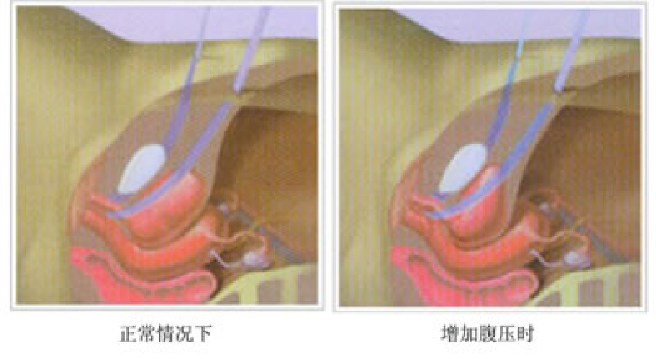 失禁的手术方法主要有以下几种,其优缺点如下: 1) 耻骨后尿道中段吊带