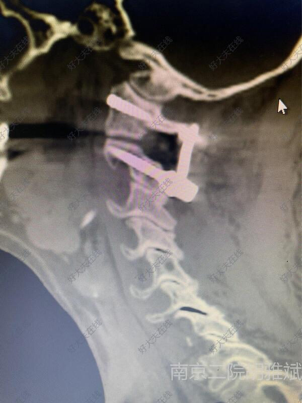 治疗中患者枢椎齿状突骨折,前期害怕手术风险保守治疗后骨折未愈合,环