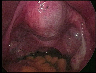 图4 腹腔镜下观子宫及双侧卵巢与输卵管.bmp