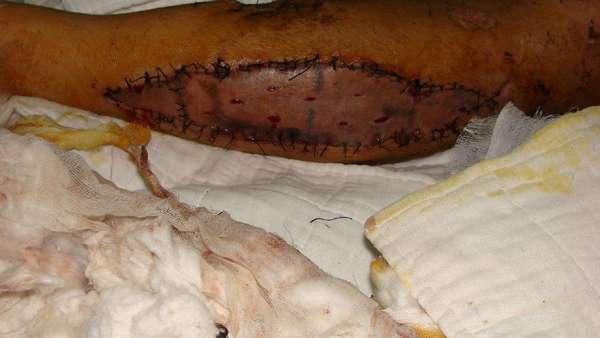 骨筋膜室综合症的治疗 - 好大夫在线