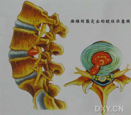 腰椎间盘突出症详解『图解』