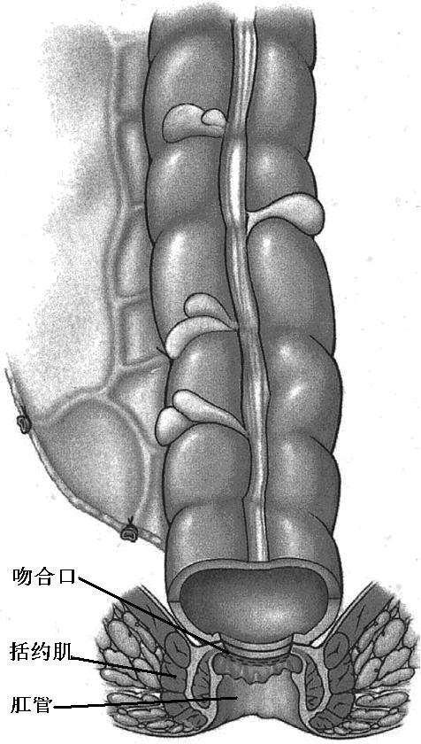 低位直肠癌保肛手术