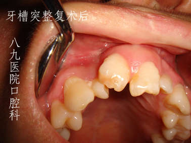 牙槽嵴裂整复术后