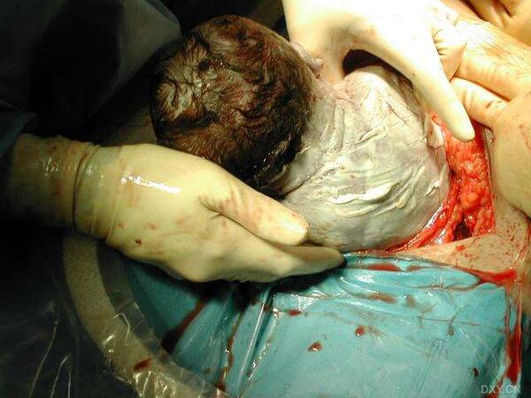 剖宫产真实图片2