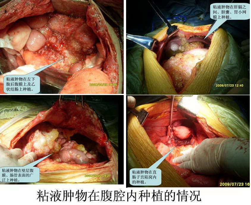 腹膜假性粘液瘤腔镜下及手术中所见