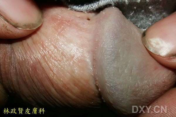 ：阴茎珍珠样丘疹表现为沿着龟头冠状沟前方排列成一圈的肉色小粒突起图1图2图3图4下图5～6：真正的尖