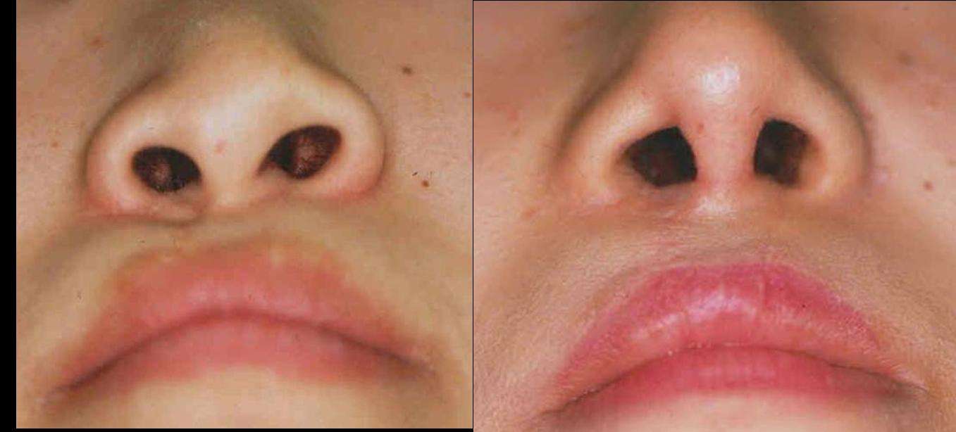 唇裂继发畸形,一般包括:上唇瘢痕,凹陷,唇弓变形,鼻子塌陷,鼻孔变形