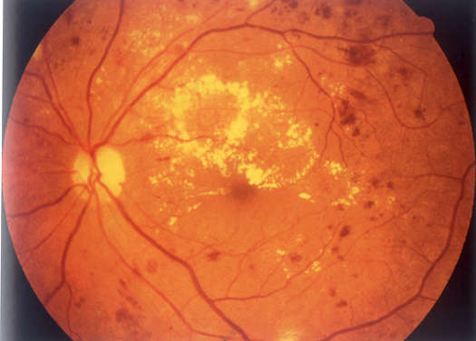 糖尿病视网膜病变的分期和各期的眼底图像