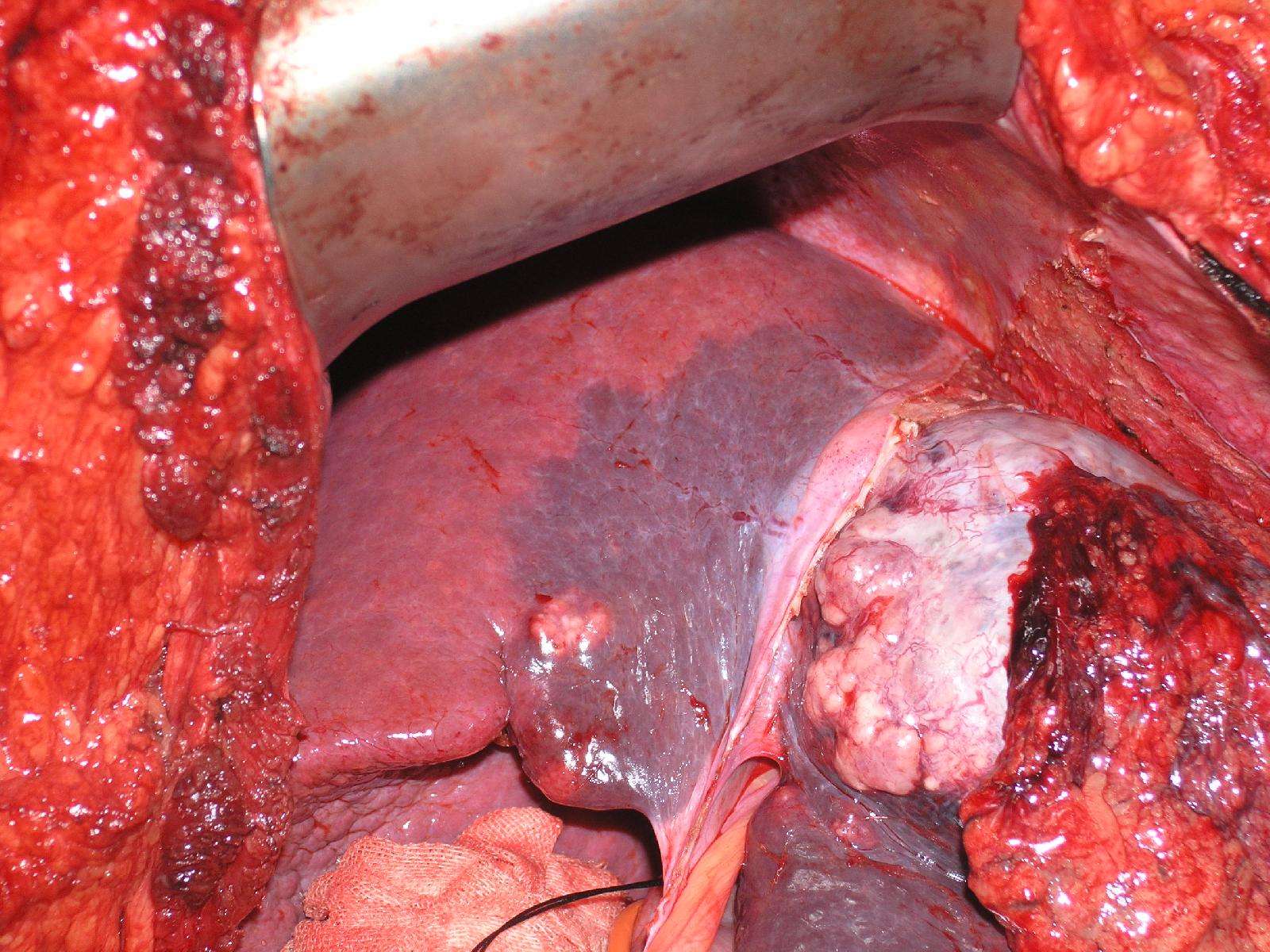 肝癌患者可望获长期生存的肝切除新方法(手术图片)-肝蒂横断法解剖性