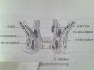 肛周脓肿分类