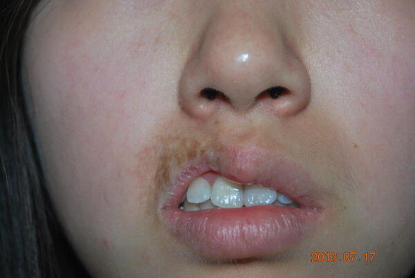 唇部血管瘤修复同位素治疗继发畸形案例
