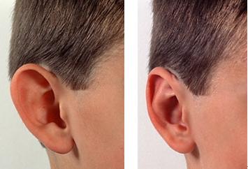 招风耳(prominent ear)的治疗