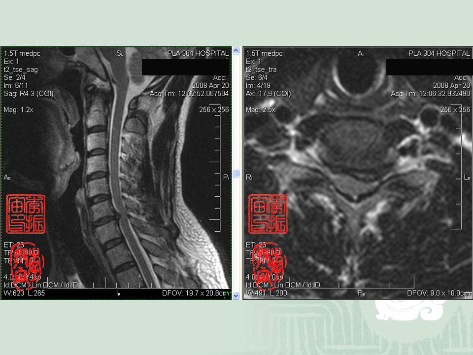 颈椎核磁共振显示c6-7椎间盘突出,压迫左侧c7神经根.