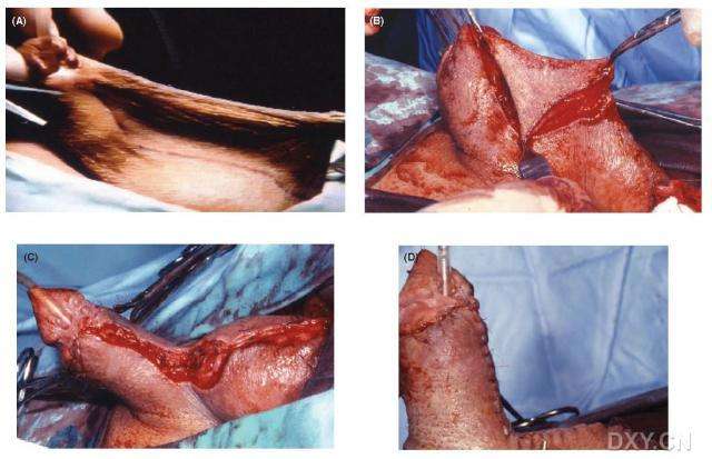 蹼状阴茎的手术术式选择