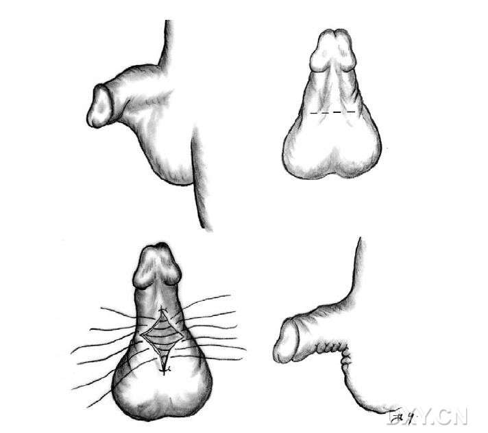蹼状阴茎 包皮环切时,阴茎腹侧皮肤切除过多,术后在愈合过程中阴囊
