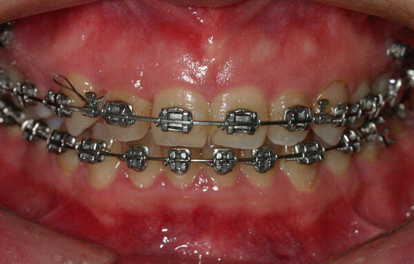 大部分牙齿矫正是要通过固定矫治器来完成的.
