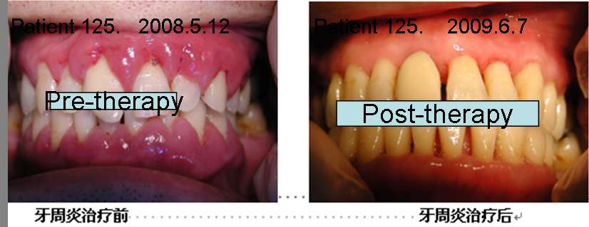牙周炎治疗前后比较