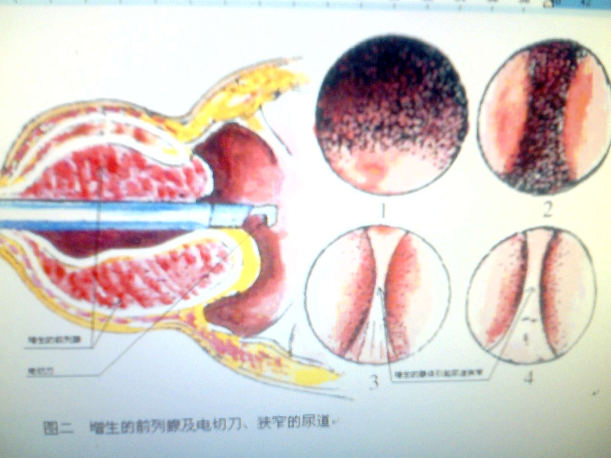 前列腺微创手术示意图