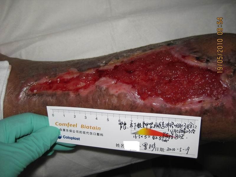 治疗后80天肌腱被肉芽组织覆盖,伤口明显缩小