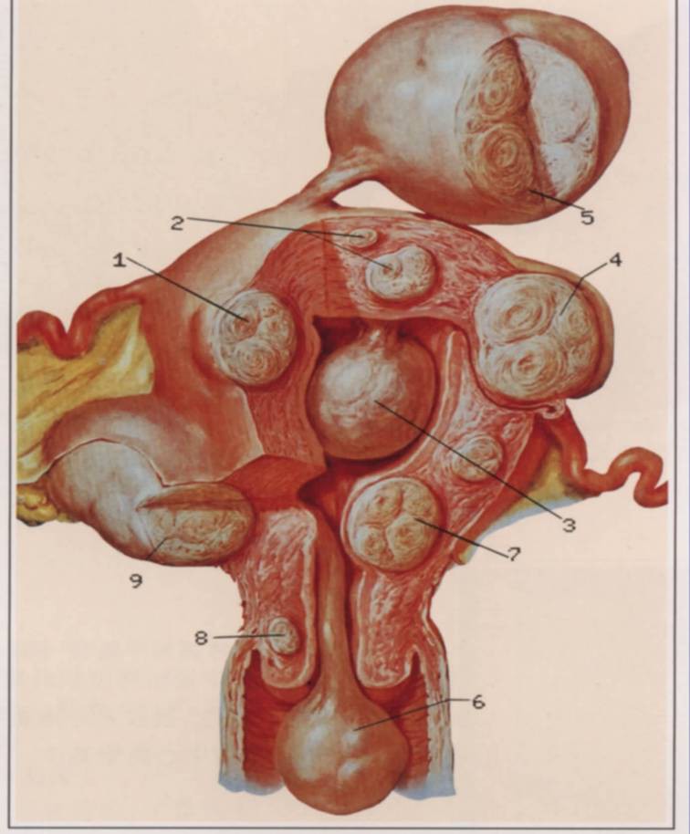 子宫肌瘤之——本质和分类