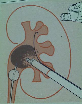 对肾内疾病进行诊断和治疗的一种手术方法经皮肾镜下气压弹道联合超声
