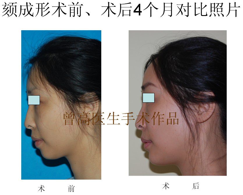 颏成形术前术后4个月对比照片