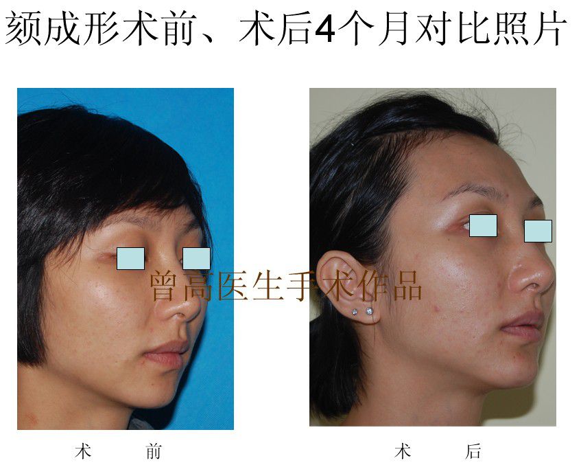 颏成形术前术后对比照片