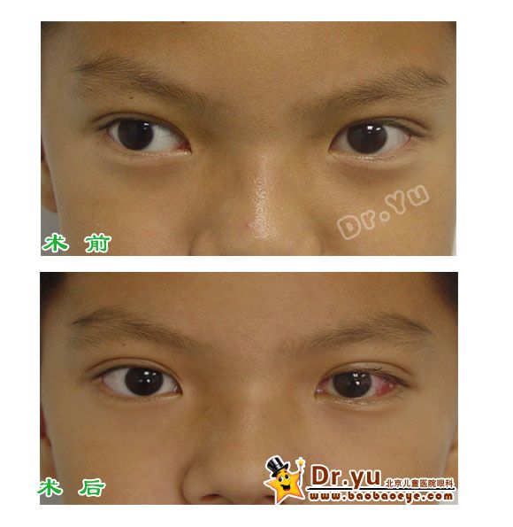 患儿依某男间歇性外斜左眼注视时右眼可见大度数的外斜术后斜视矫正好