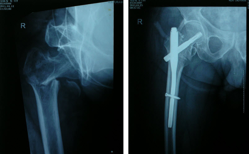 老年髋部骨折股骨颈骨折和股骨转子间骨折的治疗