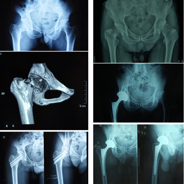 老年髋部骨折股骨颈骨折和股骨转子间骨折的治疗