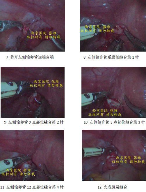 腹腔镜下输卵管吻合术