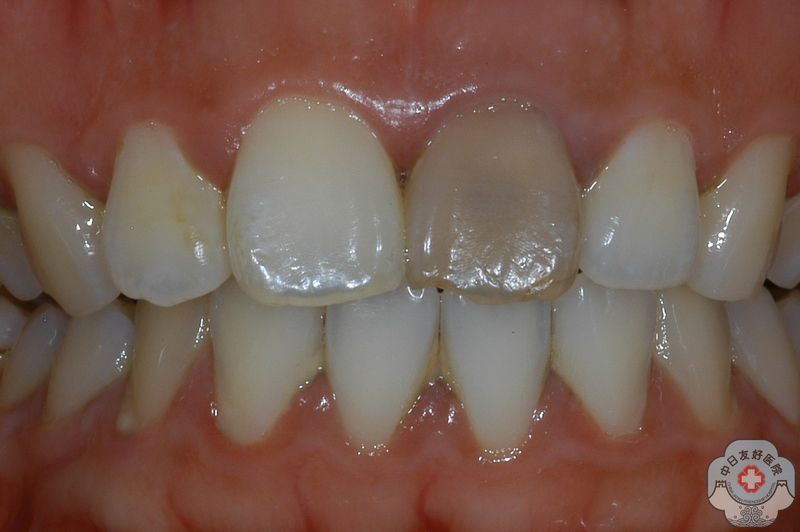由于各种原因导致 牙髓坏死,患牙在坏死后都会有不同
