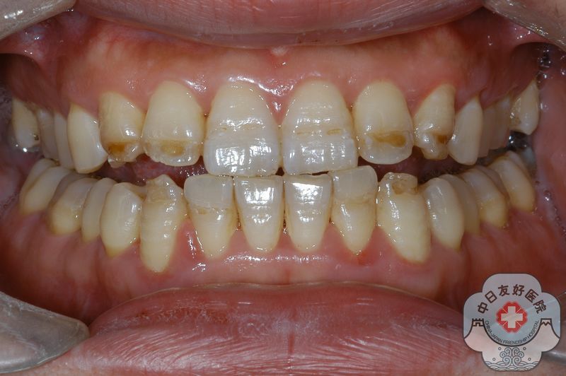 牙齿釉质发育不全树脂美容修复