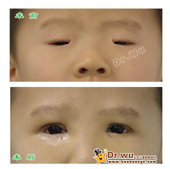 患儿周某男先天性小睑裂综合征,双眼睑裂小,双眼上睑下垂内眦赘皮.
